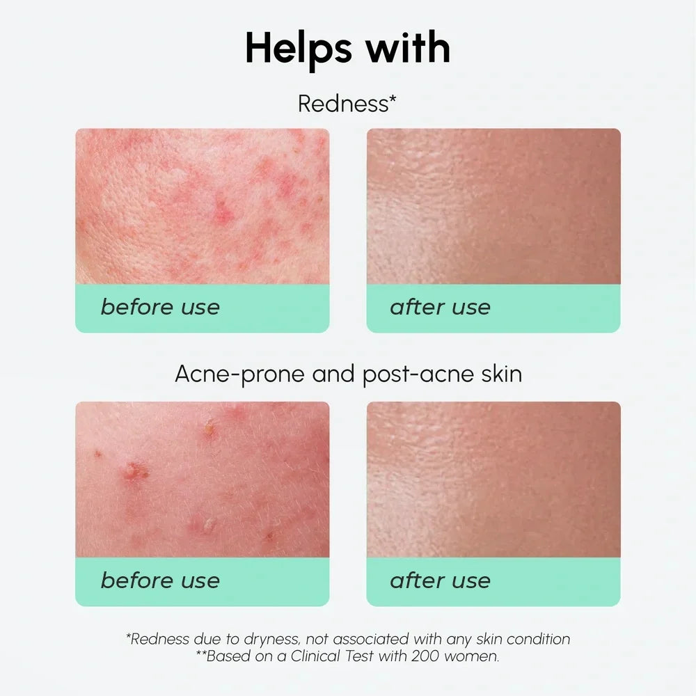 Azelaic Acid Calming Serum